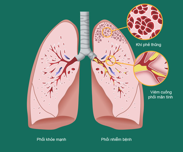 hình ảnh bệnh phổi tắc nghẽn