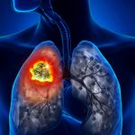 Ung thư phổi giai đoạn đầu, 2 3 và cuối sống được bao lâu?