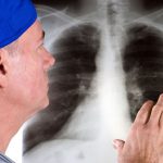 Bệnh xơ phổi có chữa được không, sống được bao lâu?