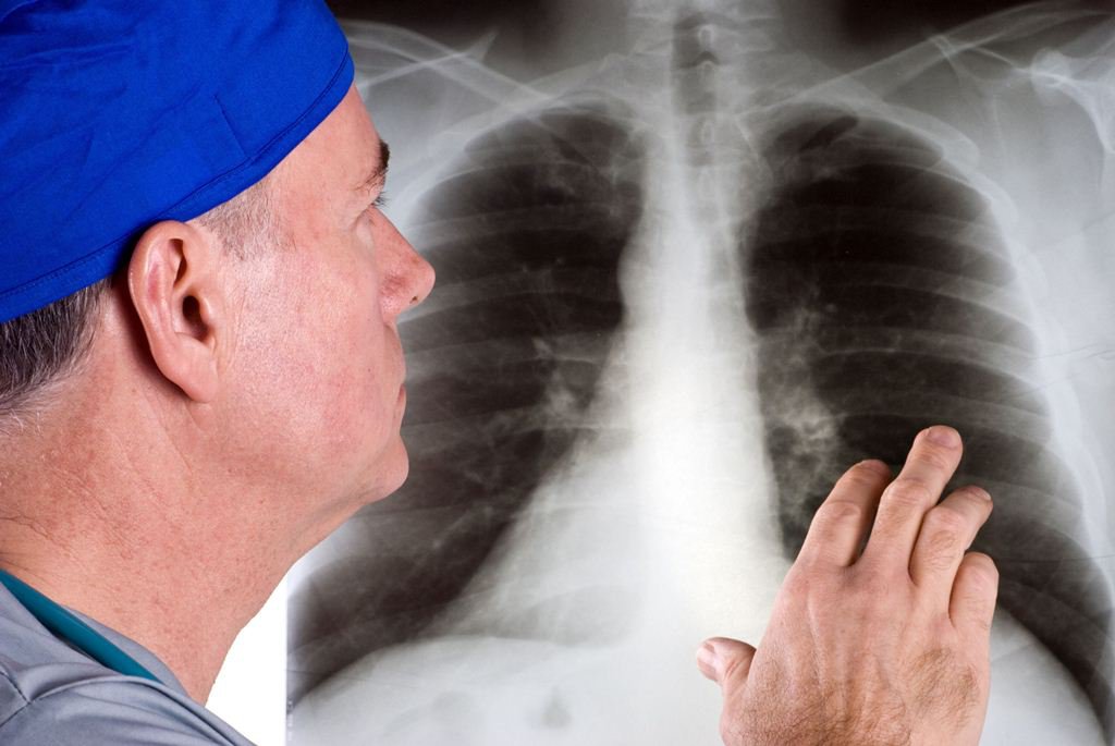 Bệnh xơ phổi có chữa được không, sống được bao lâu? - Kinhtenongthon