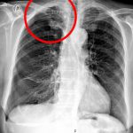 Xẹp phổi là bệnh gì? Nguyên nhân, hình ảnh và điều trị