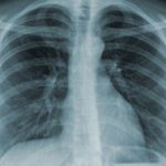 Hình ảnh chụp x-quang phổi bình thường