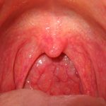 Hình ảnh viêm họng và vòm họng bình thường