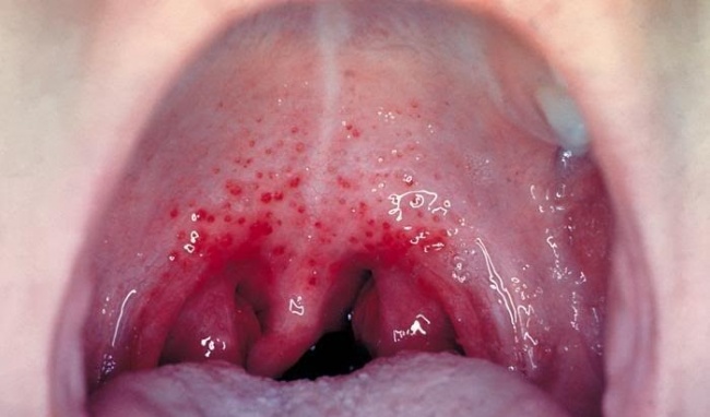 viêm họng do virus liên cầu khuẩn