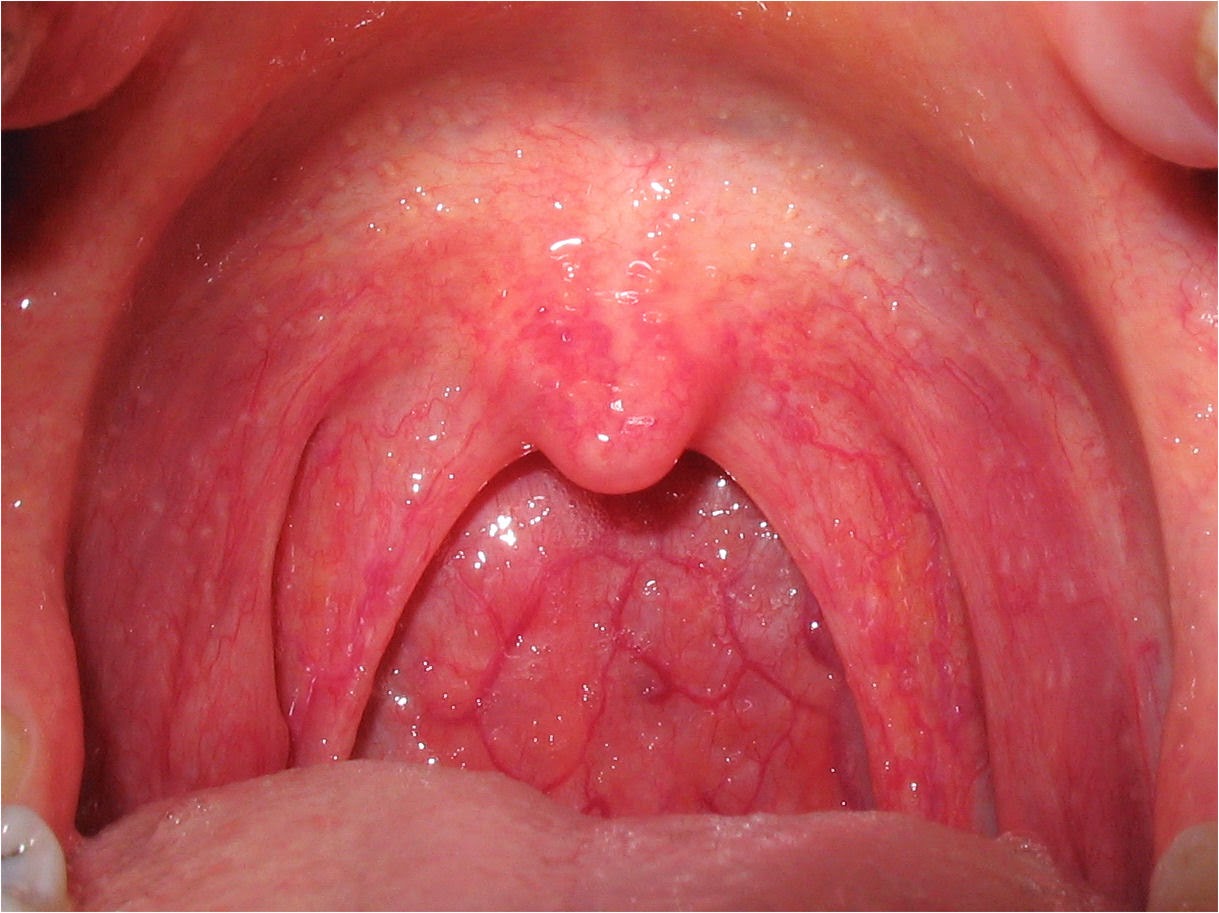 viêm họng hạt triệu chứng