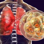 Viêm phổi thùy là gì? Biểu hiện và cách điều trị