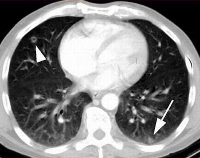 hình ảnh chụp ct phổi