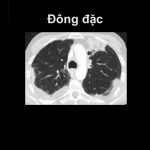 Hội chứng đông đặc phổi có nguy hiểm không?