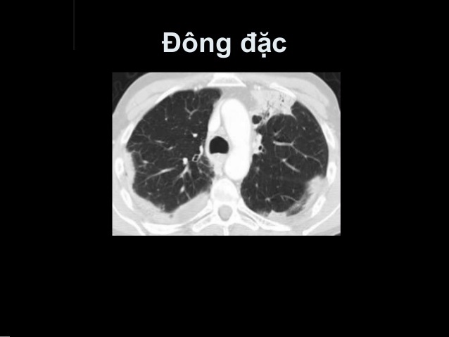 hội chứng đông đặc phổi