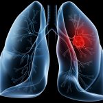 Bị sưng phổi tuyệt đối không thể chủ quan