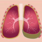 Viêm màng phổi: Triệu chứng, nguyên nhân và cách nhận biết sớm