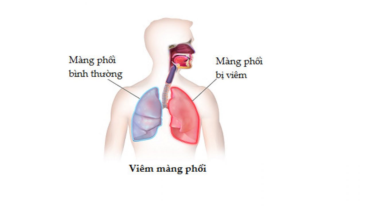 viêm màng phổi là gì