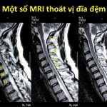 Chụp MRI thoát vị đĩa đệm là phương pháp gì? Có chính xác không?