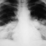 Bệnh phổi trắng có nguy hiểm không? Triệu chứng, phòng ngừa