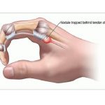 Đau khớp ngón tay trỏ là bị bệnh gì? Cách giảm đau nhanh