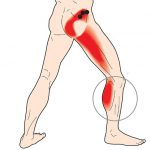Đau nhức từ mông xuống bắp chân là sao? Cách khắc phục