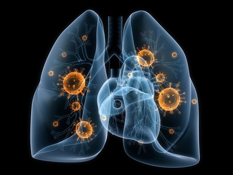 Nhiễm trùng phổi có nguy hiểm không