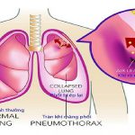 Tràn khí màng phổi có nguy hiểm không? Chăm sóc và điều trị
