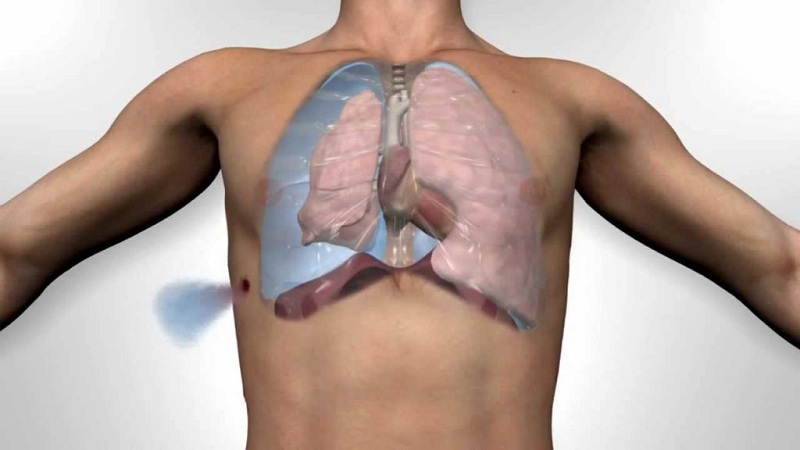 Tràn khí màng phổi có nguy hiểm không