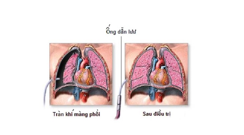 Điều trị tràn khí màng phổi