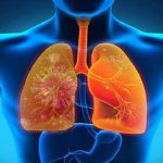 Viêm phổi hít sặc là gì? Dấu hiệu và cách điều trị
