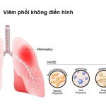 Viêm phổi không điển hình là gì? Nguyên nhân chính gây bệnh