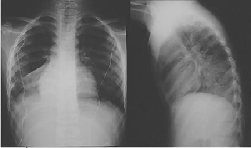 Chẩn đoán viêm phổi không điển hình