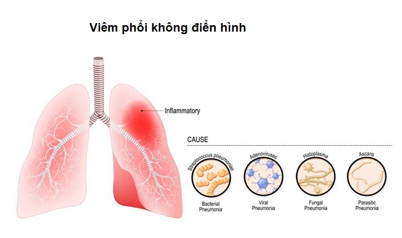Viêm phổi không điển hình