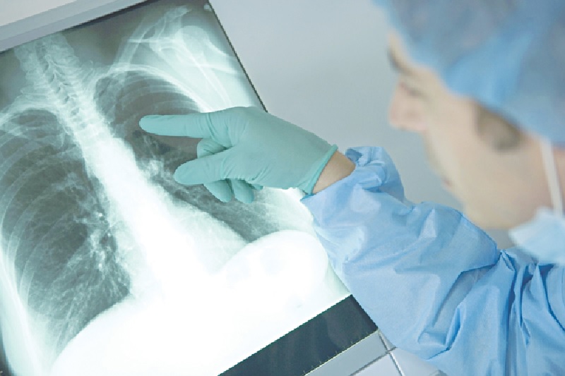 Chẩn đoán viêm phổi liên quan đến thở máy