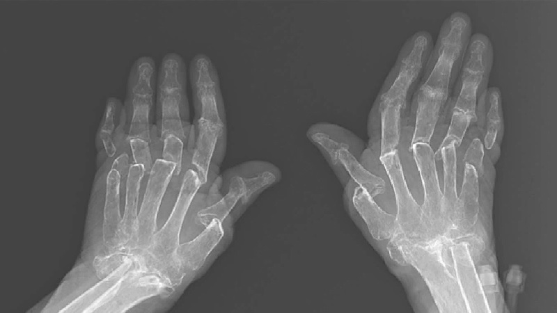 Hình ảnh X quang viêm khớp dạng thấp
