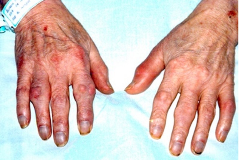 Nguyên nhân gây hạt dưới da trong viêm khớp dạng thấp