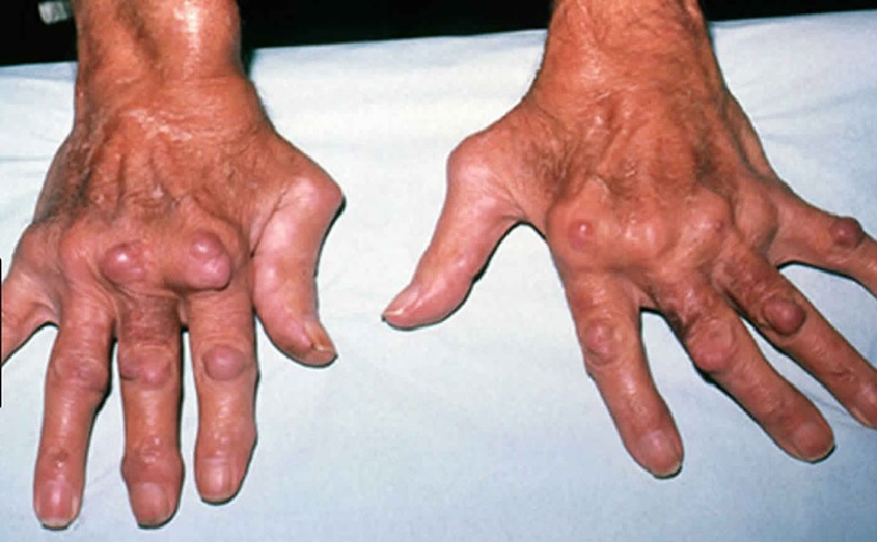 Hạt dưới da trong viêm khớp dạng thấp là gì
