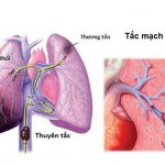 Tắc mạch phổi là gì? Có nguy hiểm không?