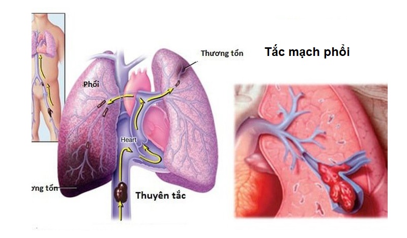 Tắc mạch phổi